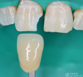 前牙ⅲ ⅳ ⅴ類樹脂充填