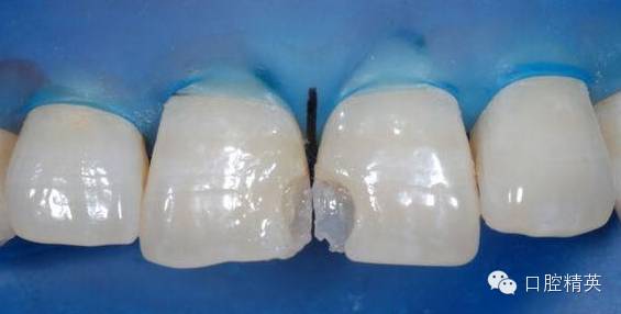 前牙樹脂分層堆塑技術及其應用